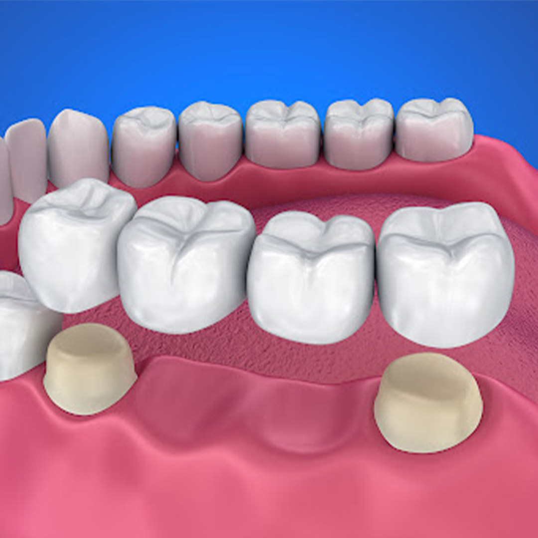 أنواع التیجان والترکیبات السنیة