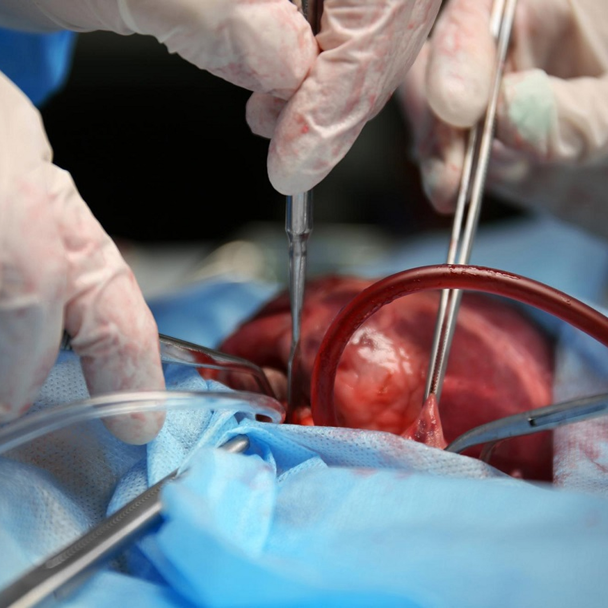 CABG